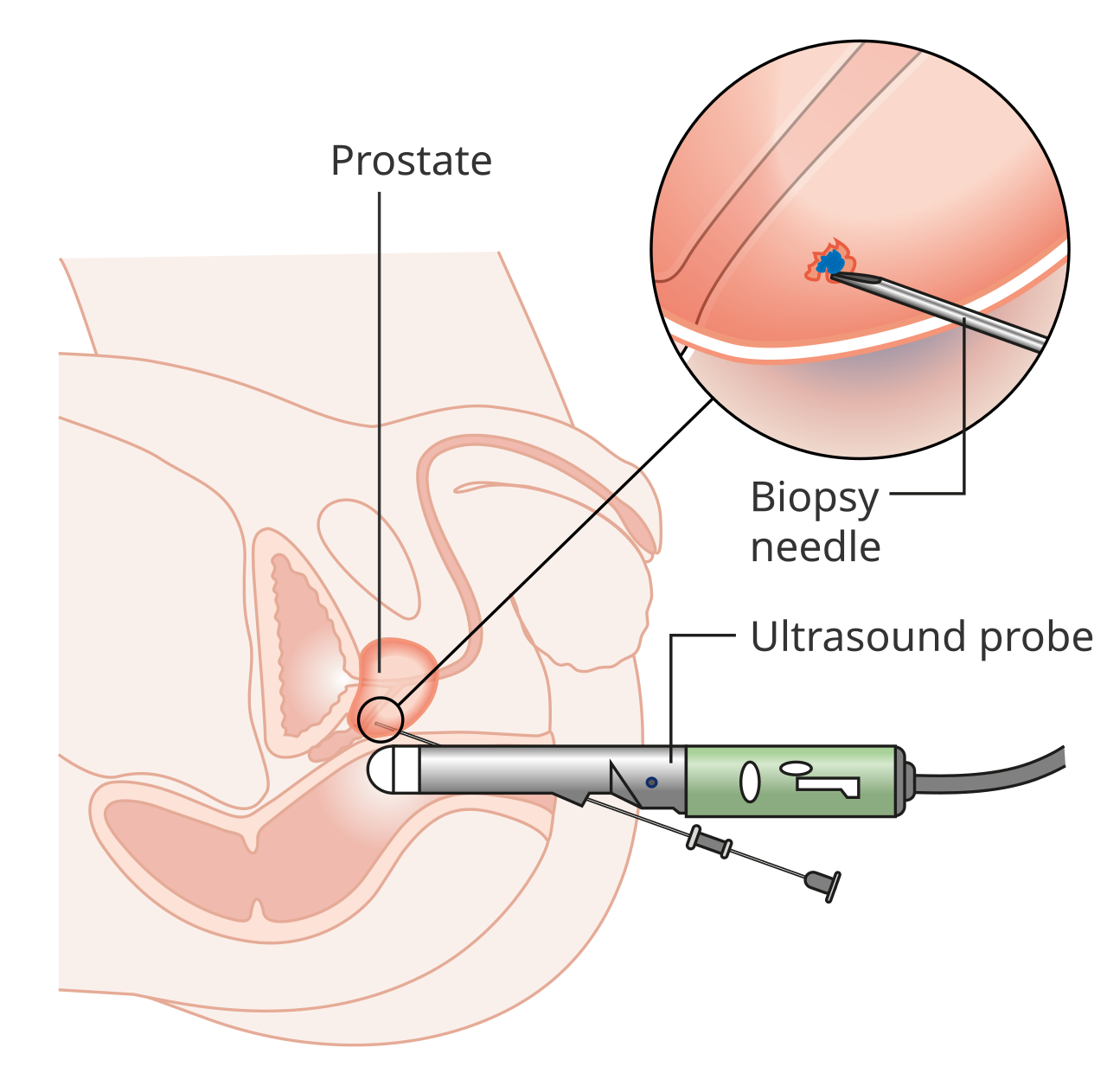Diagram of a prostate biopsy: a rectal ultrasound probe and a needle reaching the prostate