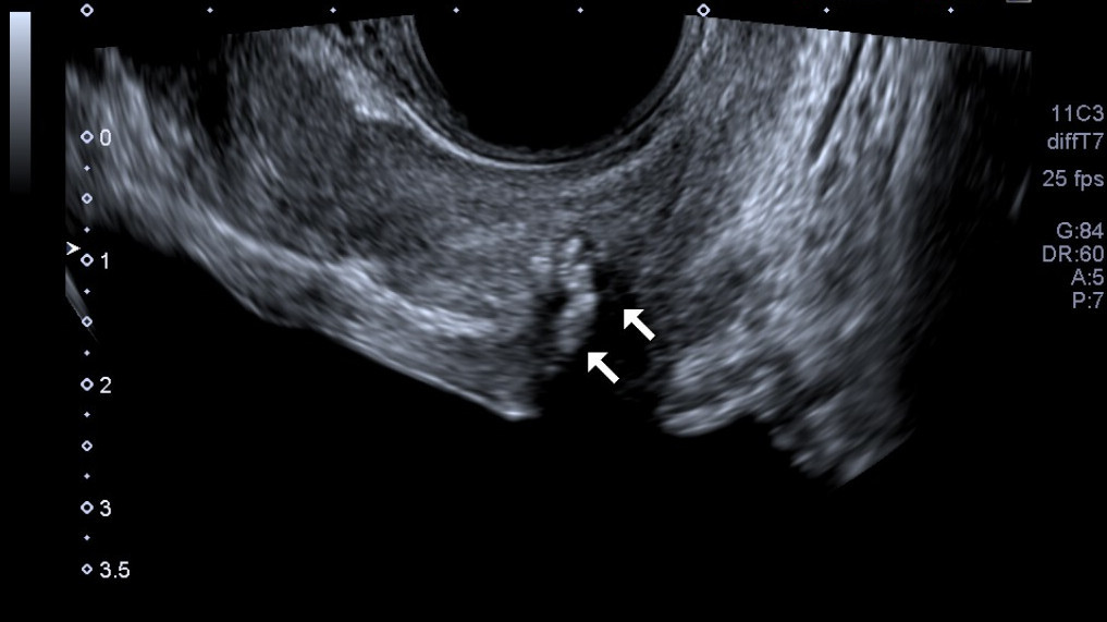 Transrectal ultrasound of the prostate gland with the probe array at the top