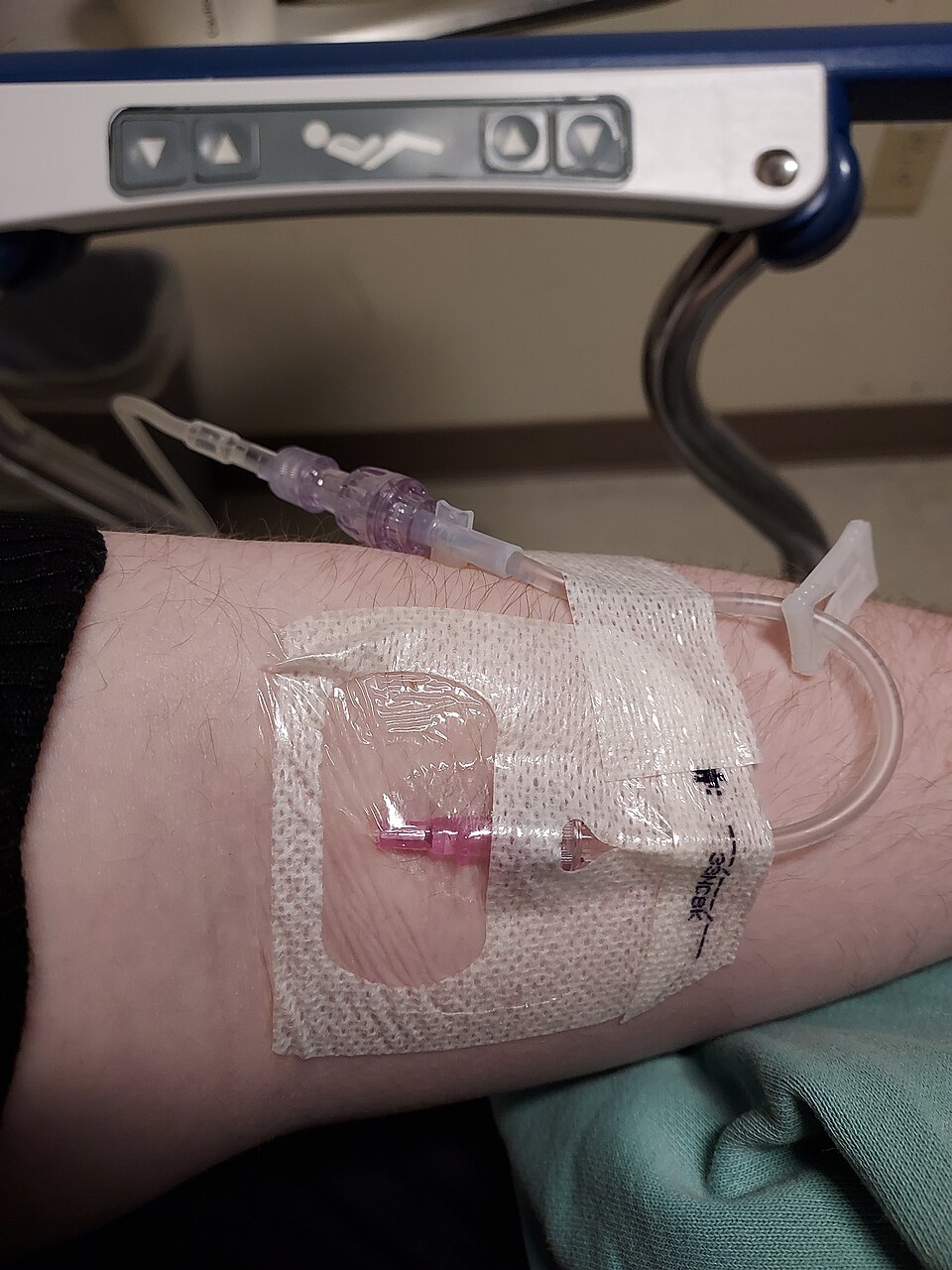 A peripheral intravenous cannula taped into a forearm with the drip line attached