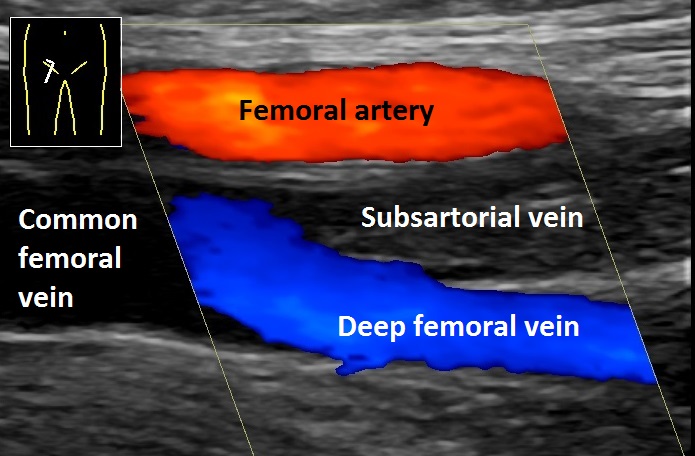 Colour ultrasound of the groin vessels, the artery shown in red and the deep veins in blue