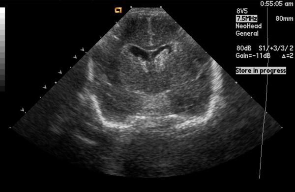 A coronal cranial ultrasound taken through the fontanelle, showing the dark fluid-filled ventricles