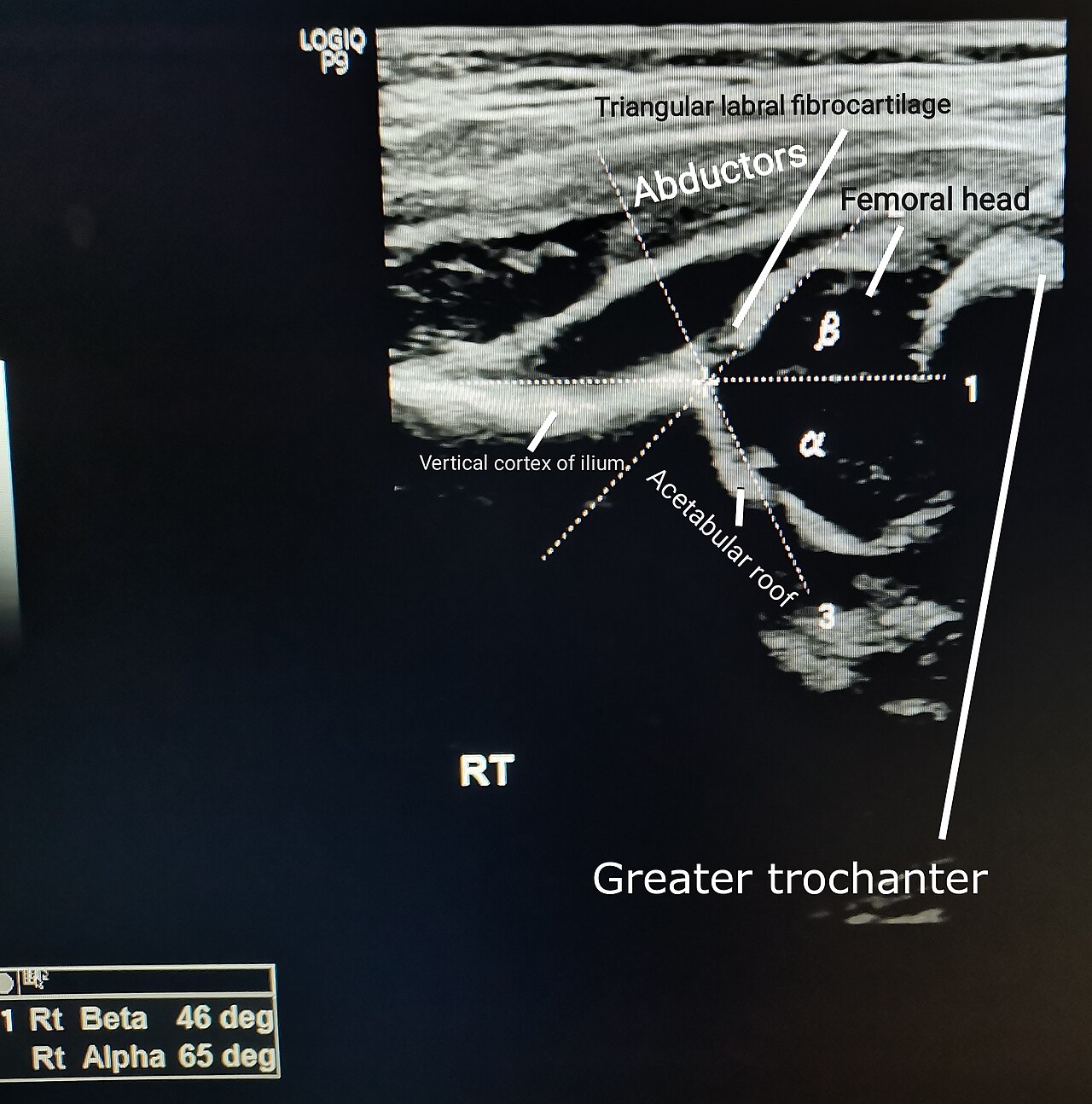 Coronal ultrasound of a normal infant hip with the femoral head, acetabular roof and labrum labelled