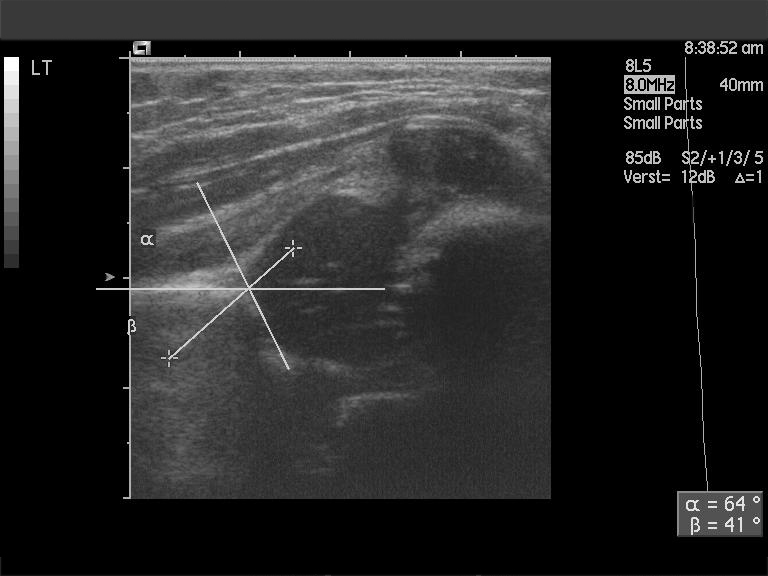 Ultrasound of a newborn hip with lines drawn to measure the socket angle