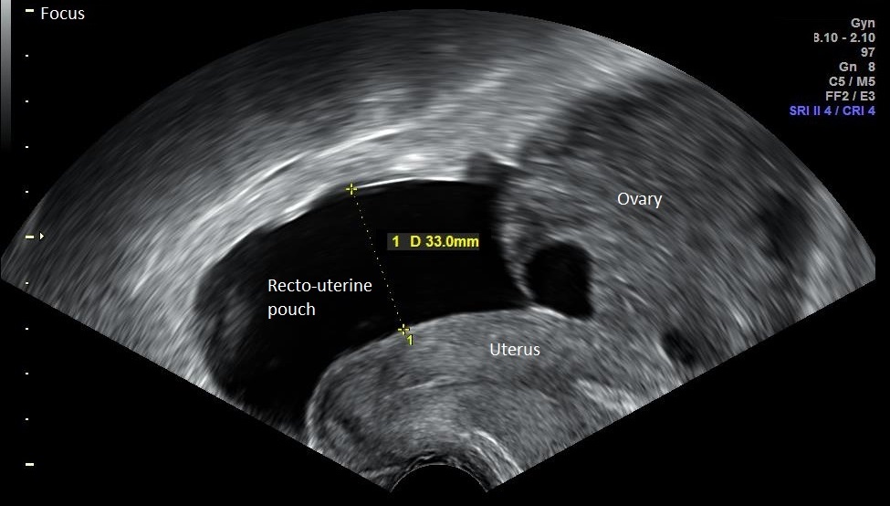 Transvaginal ultrasound showing the uterus, an ovary and fluid in the recto-uterine pouch