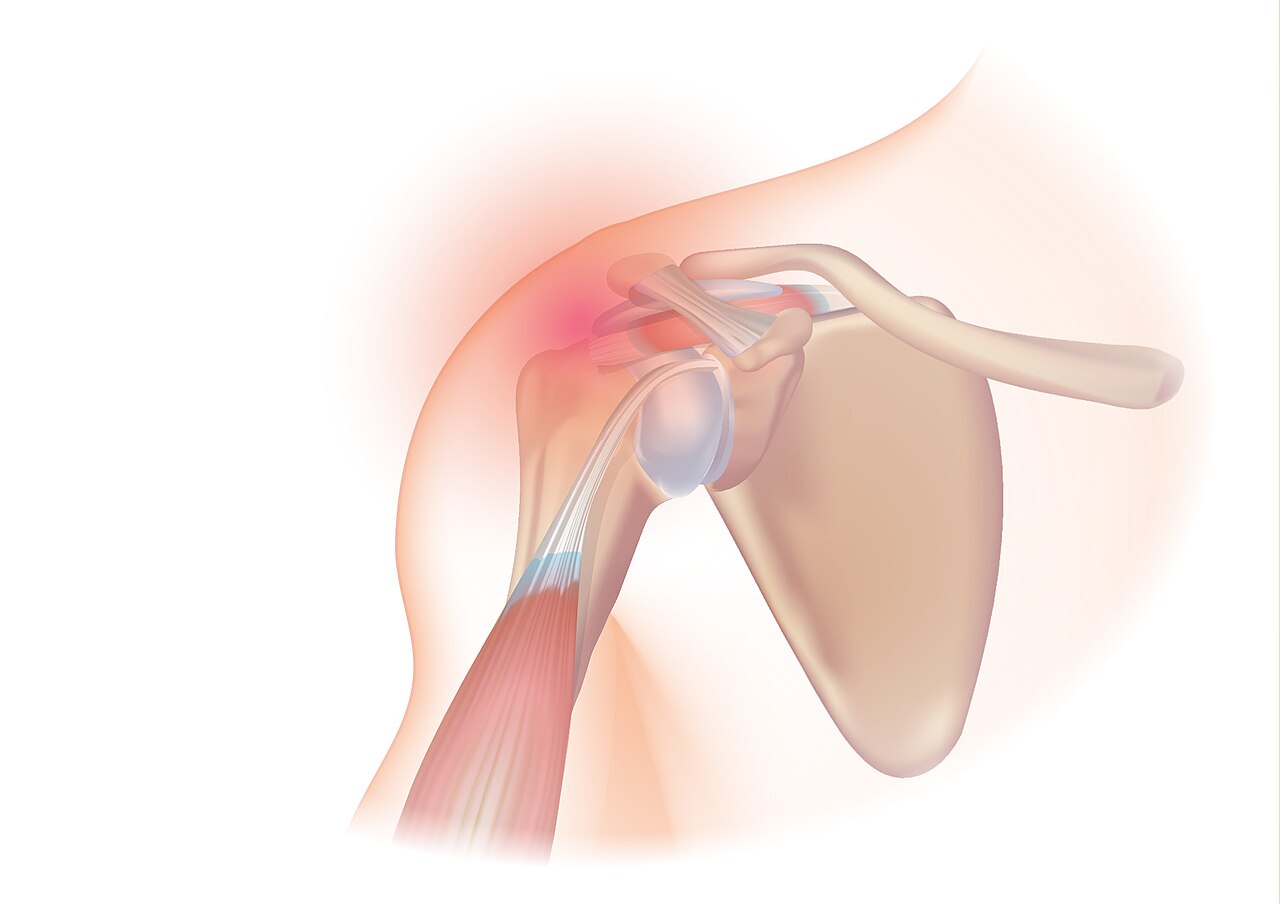 Illustration of the shoulder with the rotator cuff over the head of the upper arm bone