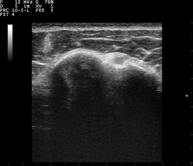 Biceps long head tendon in short axis within the bicipital groove on ultrasound