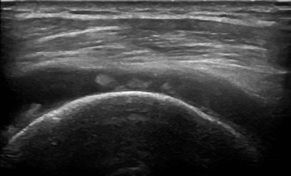 Rotator cuff tear on ultrasound over the curved head of the upper arm bone