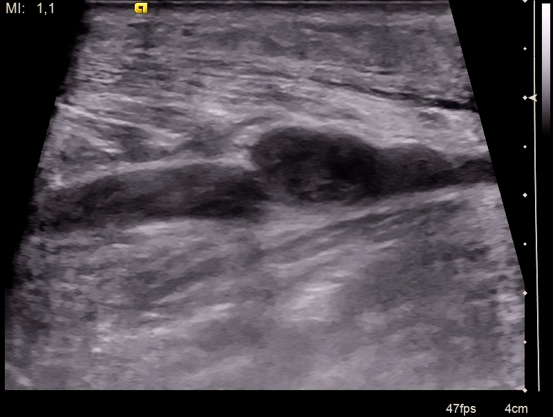 Ultrasound of a torn calf muscle showing a dark pool of blood in the gap
