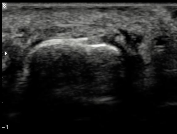 Ultrasound of a fractured foot bone showing a step in the bright surface of the bone