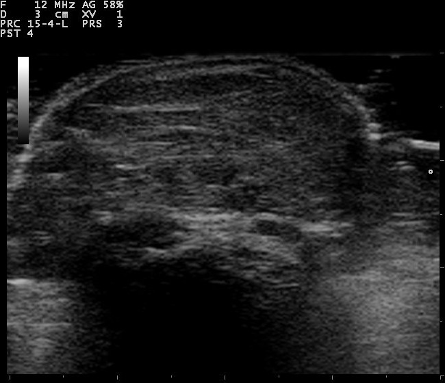 Ultrasound of a lipoma, a flat oval mass in the fat with internal striations